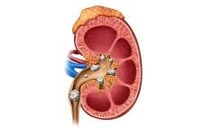 Kidney Stones
