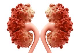 Polycystic Kidney Disease