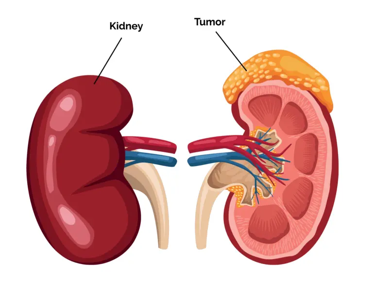 Acute Kidney Failure